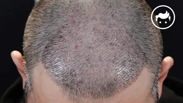 10 14 days after hair transplant