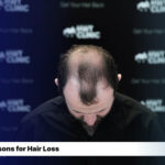 10 Reasons for Having a Hair Loss