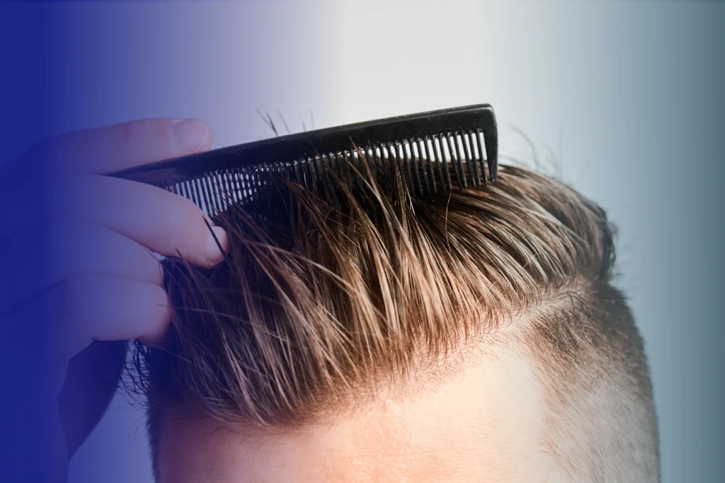 9 best proven hair loss tretments for men