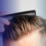 Die 9 besten bewährten Behandlungen gegen Haarausfall für Männer