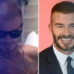 10 Celebrities With Hair Transplants