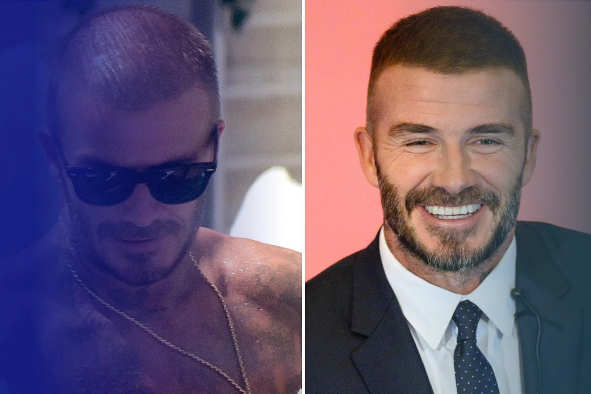 ten celebrities who have hair transplants