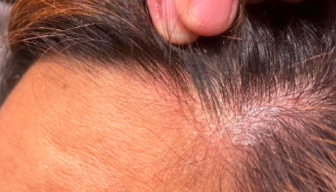 Causes of Hair Fungus