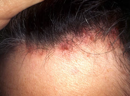 Hair Fungus Symptoms