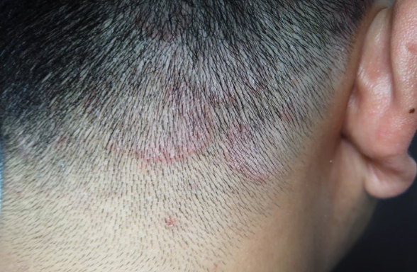 How to Get Rid of Hair Fungus