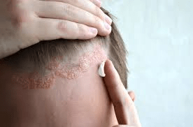 Symptoms of Seborrheic Dermatitis