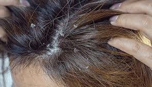 What is Seborrheic Dermatitis