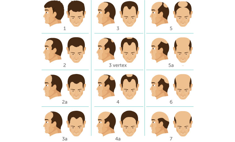 What is the Norwood Scale