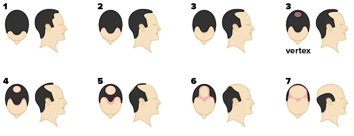 Your guide to the Norwood Scale