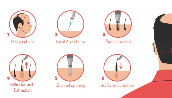 follicular unit extraction fue