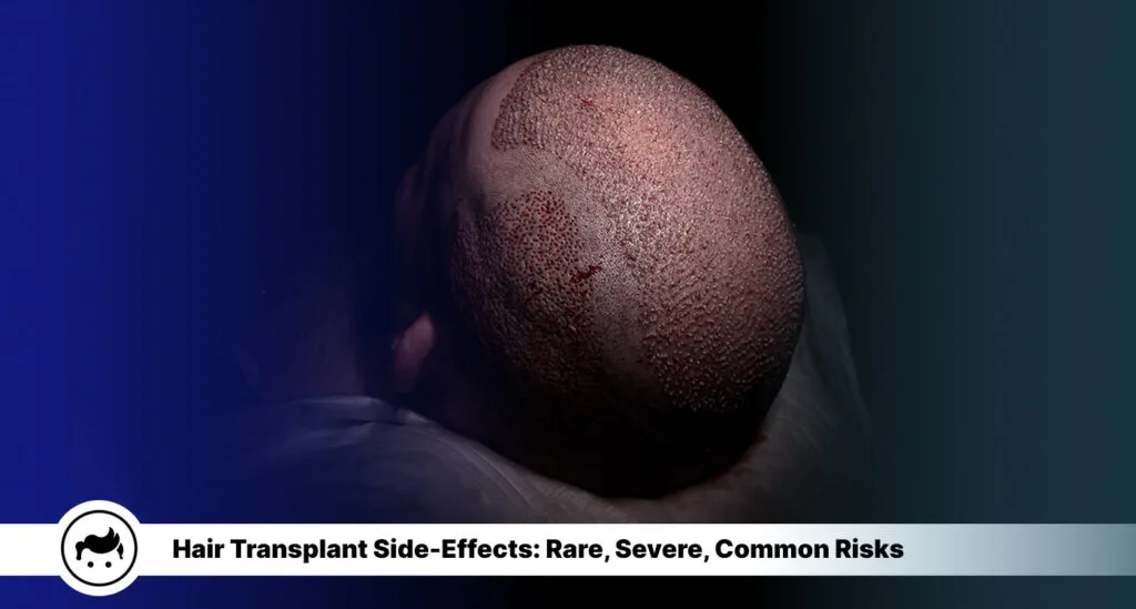 15 Side-Effects of Hair Transplant Surgery