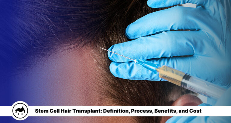 Stem Cell Hair Transplant: Definition, Process, Benefits, and Cost