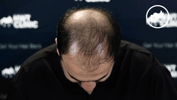 what is hair loss