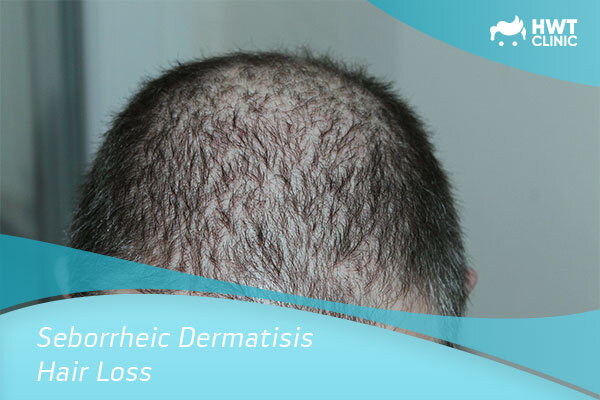 Seborrheic Dermatisis Hair Loss Causes And Treatment Hwt Clinic Blog