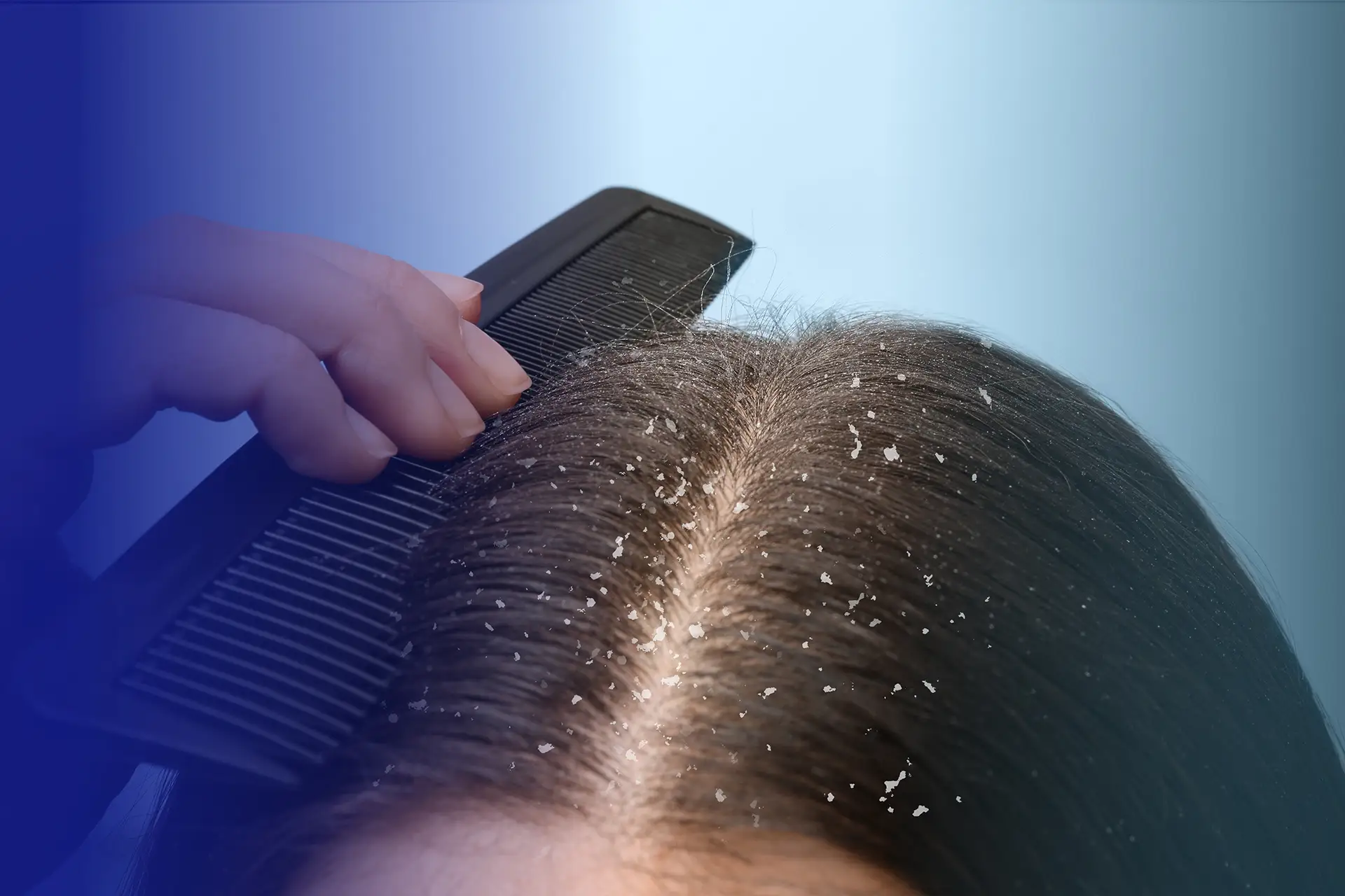 How to Get Rid of Hair Fungus |