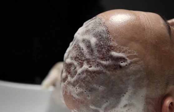 Unshaven Hair Transplant Care