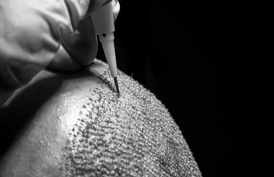 How Does an Unshaven Hair Transplant Work?