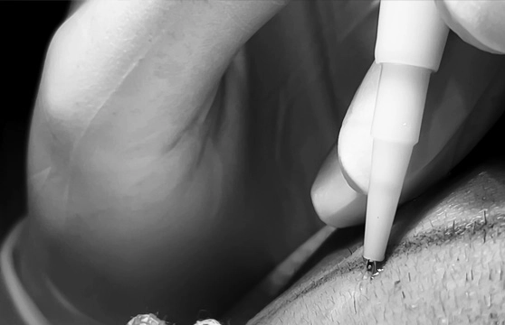 How is an Unshaven Hair Transplant Performed?