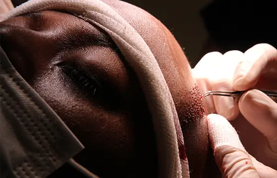 What is an Afro Hair Transplant?