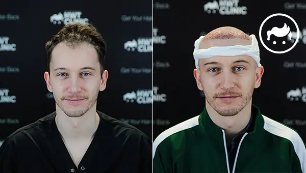 fut hair transplant before after