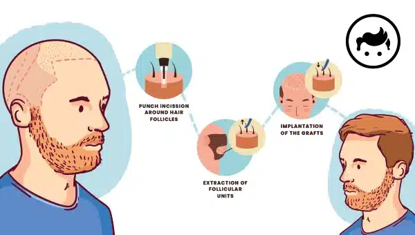 What is Hair Transplant Procedure?