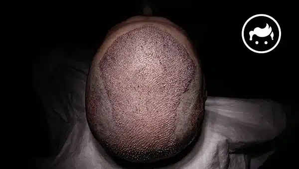 hair transplant recover
