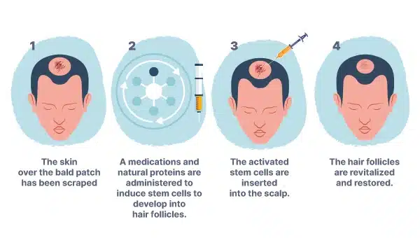 how does stem cell hair transplant work