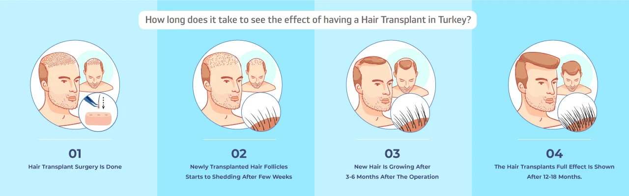 process of hair transplant in turkey