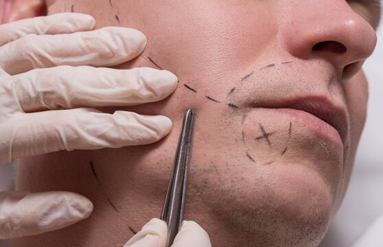 How is body hair transplant performed?