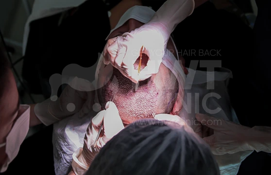 How is an FUE Hair Transplant Operation Performed?