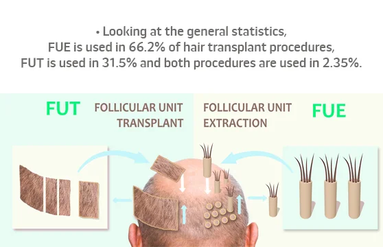 Statistiques de greffe de cheveux