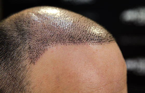 Recovery After DHI Hair Transplant